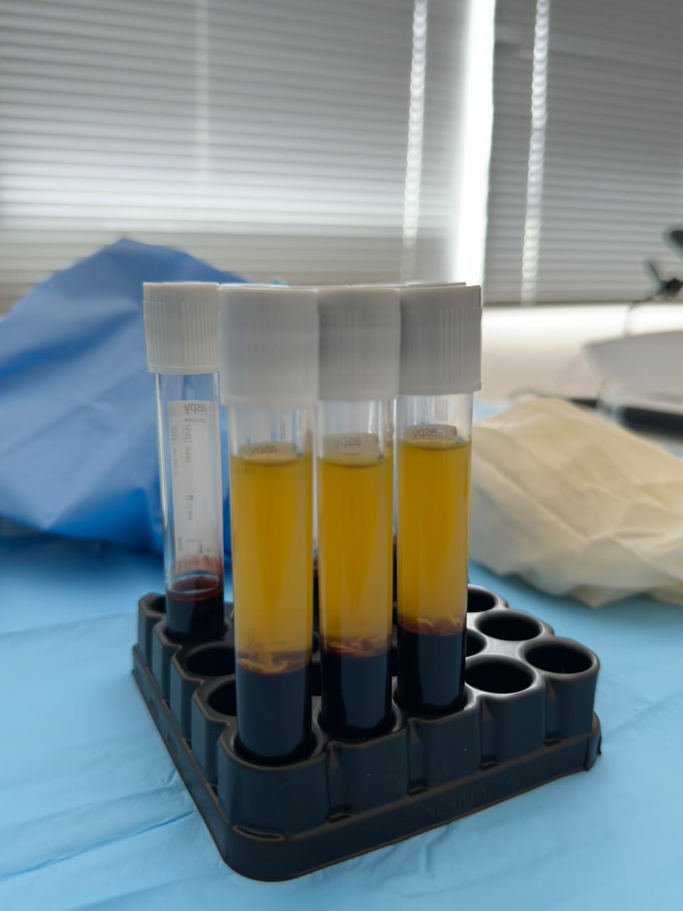 Tubos de Plasma Rico em Fibrinas (PRF) preparados para aplicação